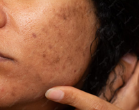 Dehydrated Skin