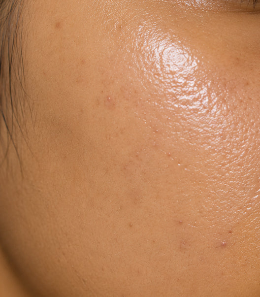 Acne Marks