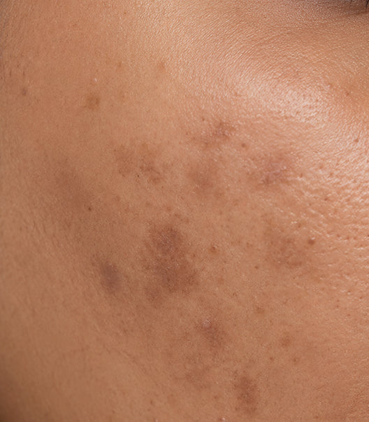 Dark Spots