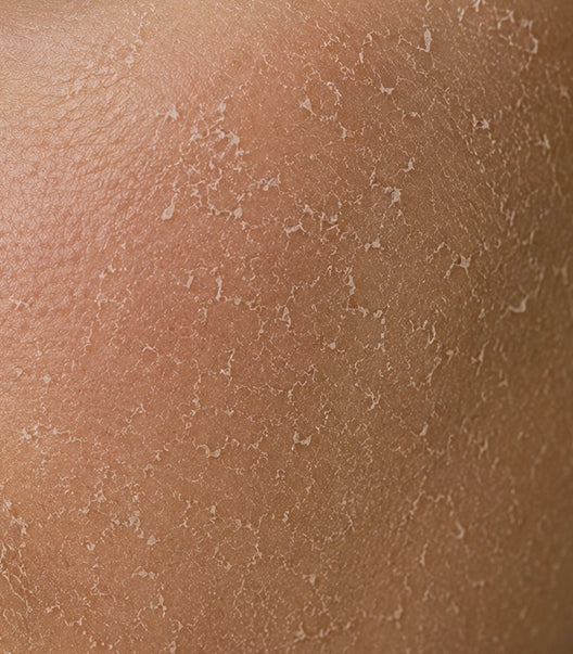Dry & Dehydrated Skin