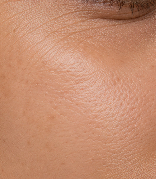 Fine Lines & Early Signs of Aging