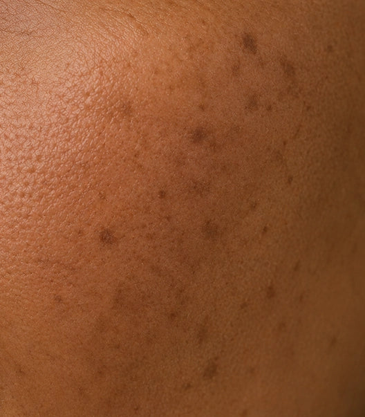 Pigmentation