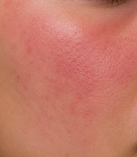Redness & Irritation