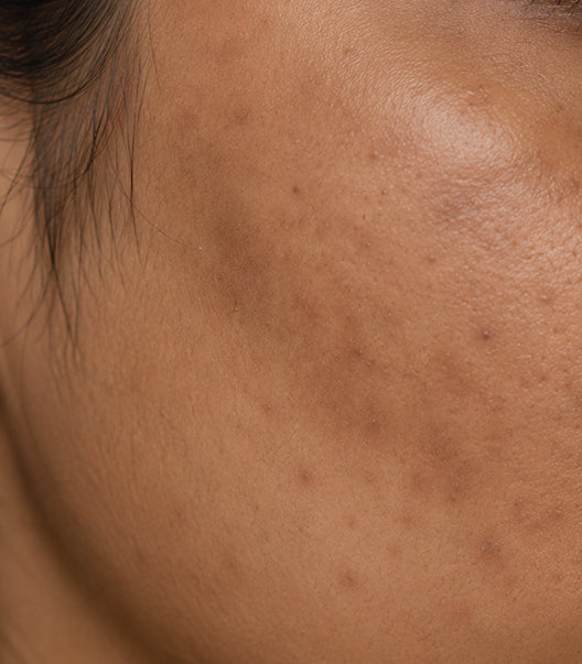 Uneven Skin Tone