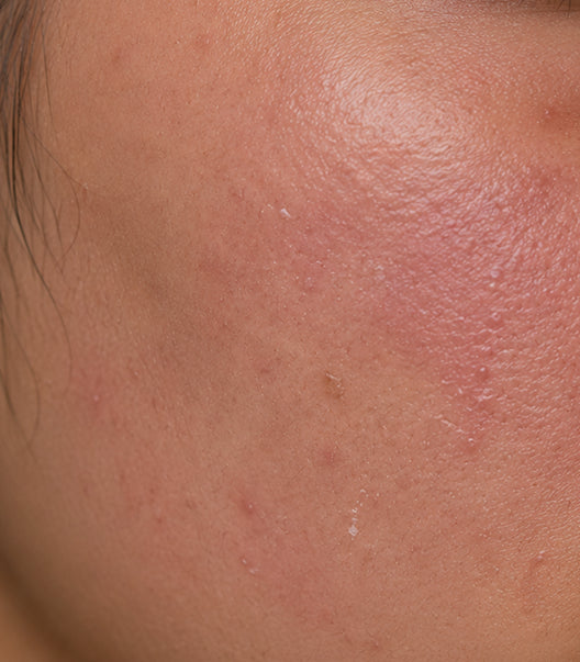 Weak Skin Barrier